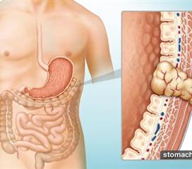胃肠道间质瘤