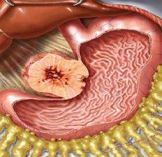 胃肠道间质瘤