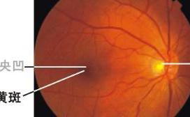 视网膜下新生血管膜