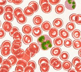 遗传性球形红细胞增多症