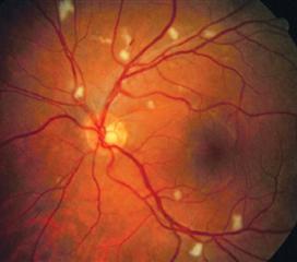 获得性免疫缺陷综合征视网膜病变