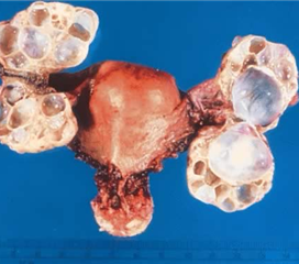 卵巢交界性肿瘤