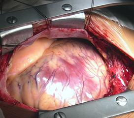 心脏脂肪瘤