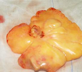 心脏脂肪瘤