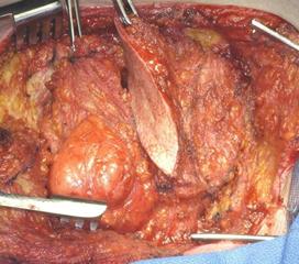 脂肪肉瘤