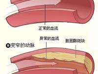 主动脉硬化