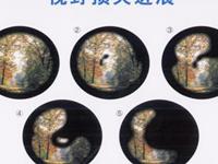 低眼压性青光眼