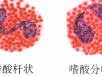 嗜酸粒细胞增多症