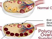 多囊卵巢综合征