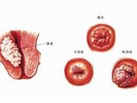 宫颈浸润癌