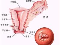 宫颈浸润癌