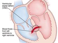 心室间隔缺损