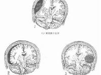 急性硬脑膜外血肿