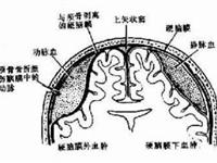 急性硬脑膜外血肿