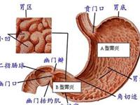 急性糜烂性胃炎