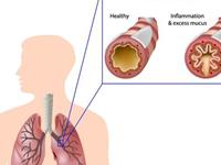 慢性支气管炎