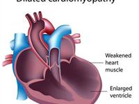 扩张型心肌病