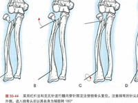 桡骨头骨折