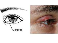 眼眶蜂窝织炎