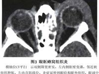 眼眶蜂窝织炎