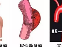 股动脉瘤