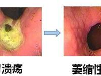 胃溃疡出血