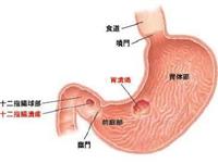 胃溃疡出血