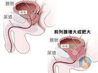膀胱颈挛缩