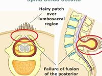 隐性脊柱裂