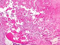 感染性心内膜炎