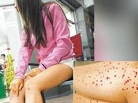 潜伏梅毒
