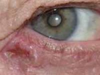 眼睑基底细胞癌
