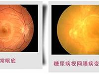 糖尿病视网膜病变