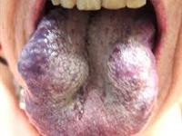 舌部血管瘤