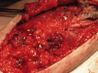 食管血管瘤