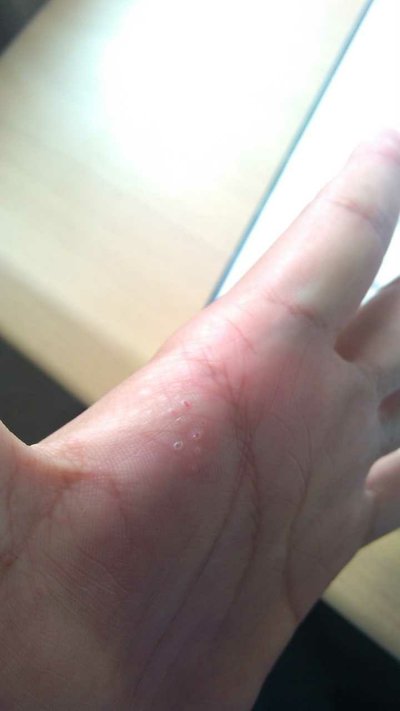 手上长疱疹是什么原因?