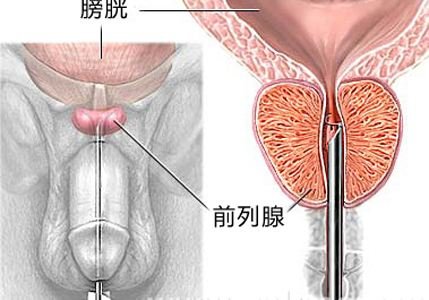 彩超前列腺增大是什么原因?