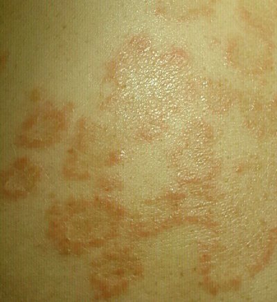 玫瑰糠疹快好了是什么症状?