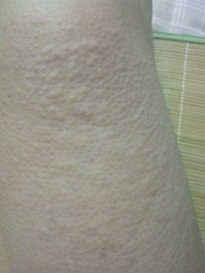 特发性荨麻疹症疹的症状
