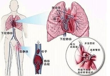 肺栓塞