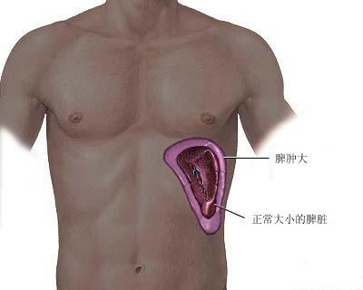 脾肿大