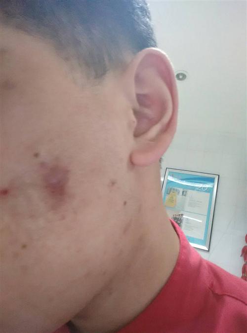 痘疤
