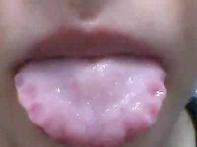 脾湿