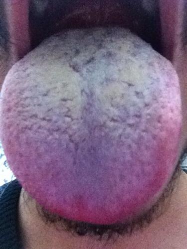 舌苔黄