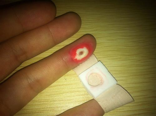鸡眼