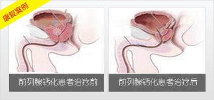 前列腺钙化