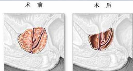 前列腺钙化