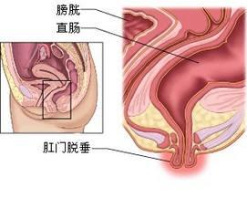 直肠脱垂