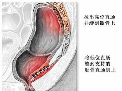 直肠脱垂