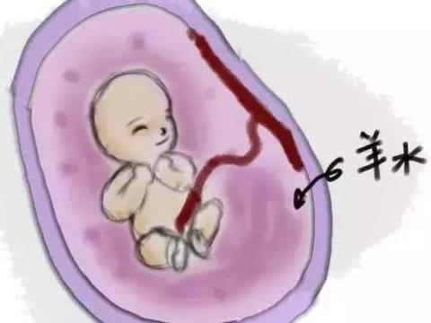羊水过多